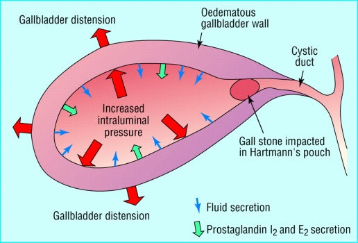 Cholecystitis (acute)