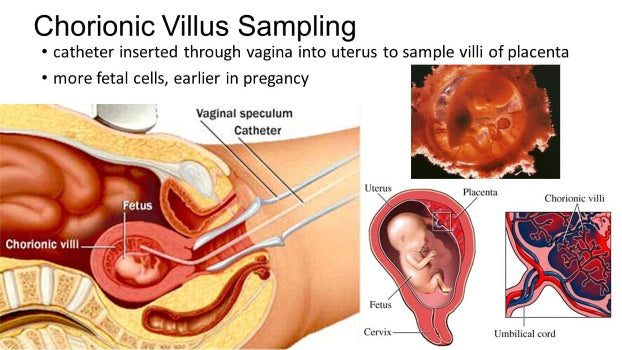 Chorionic villus sampling