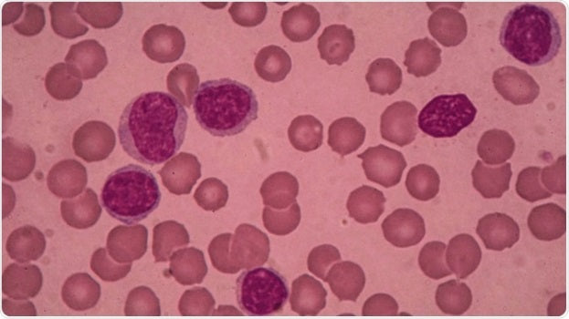 Chronic lymphocytic leukaemia