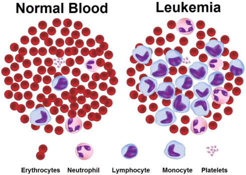 Chronic myeloid leukaemia