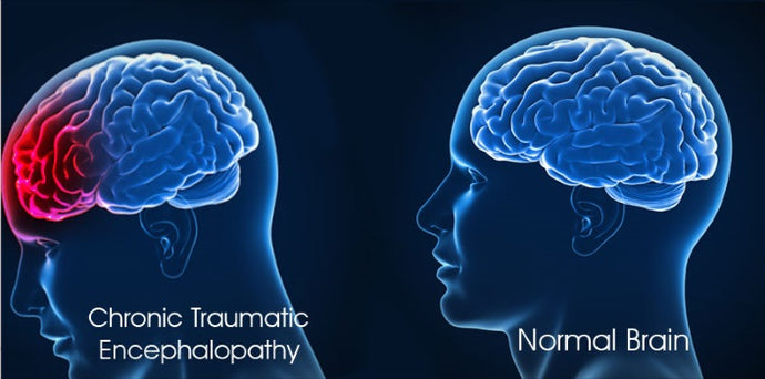 Chronic traumatic encephalopathy