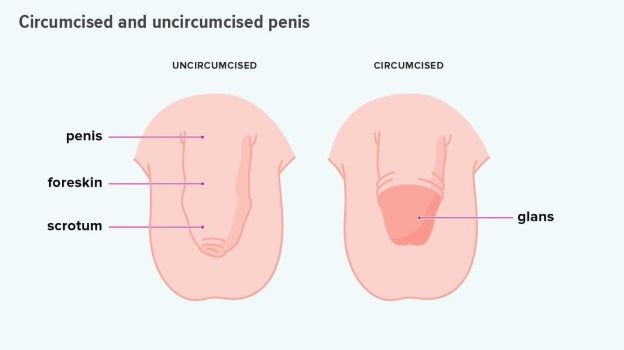 Circumcision in boys