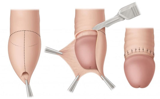 Circumcision in men