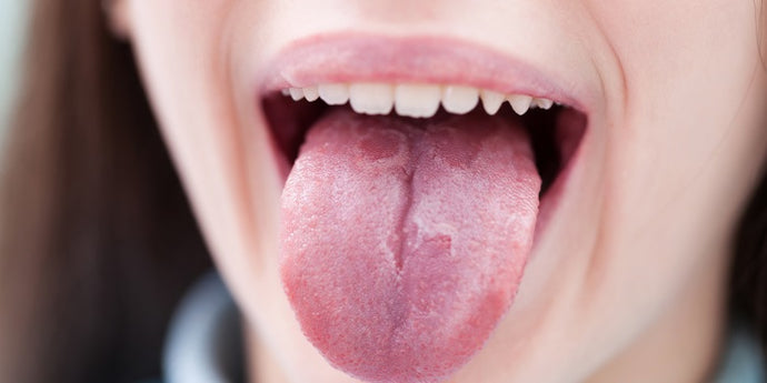 Coated or white tongue