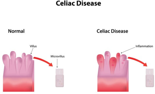 Coeliac disease