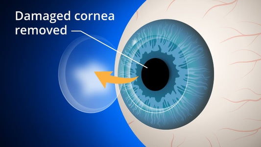 Cornea transplant