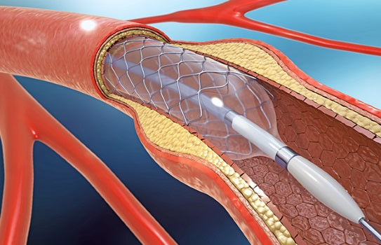 Coronary angioplasty and stent insertion