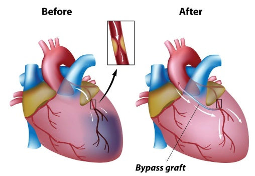 Coronary artery bypass graft