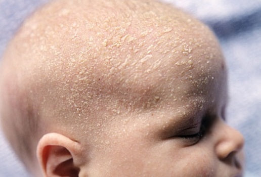 Cradle cap