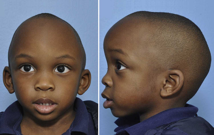 Craniosynostosis