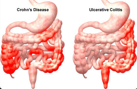 Crohn's disease