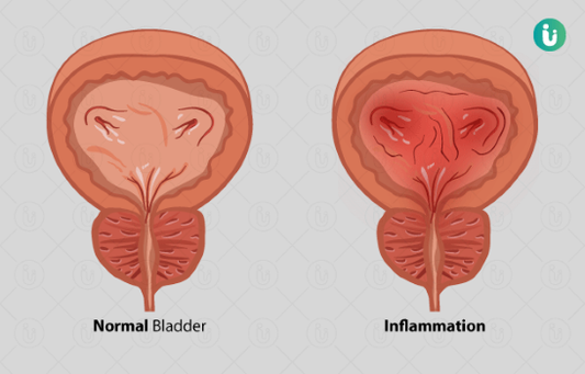 Cystitis