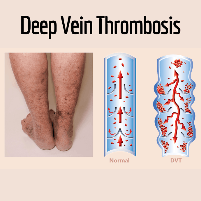 DVT (deep vein thrombosis)