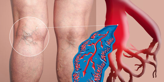 Deep vein thrombosis (DVT)