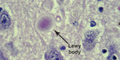 Dementia with Lewy bodies