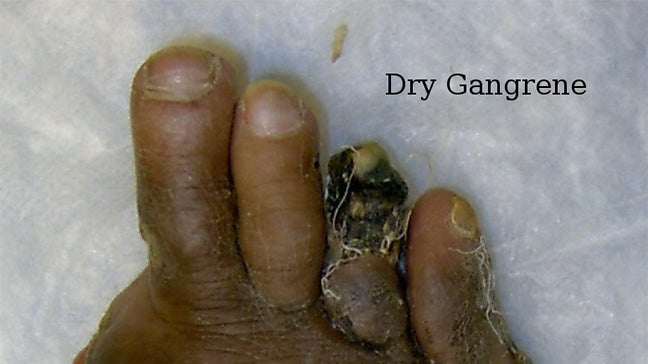 Gangrene