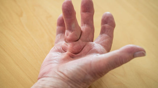 Dupuytren's contracture