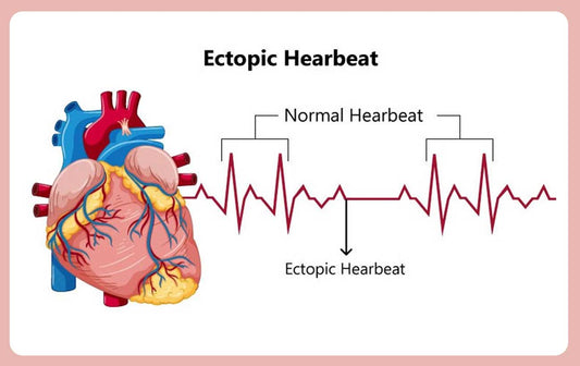 Ectopic beats