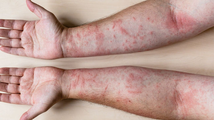 Eczema (contact dermatitis)