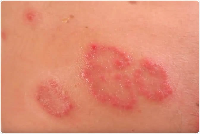 Eczema (discoid)