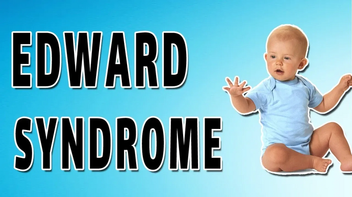 Edwards' syndrome (trisomy 18)