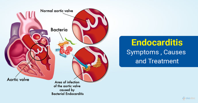 Endocarditis