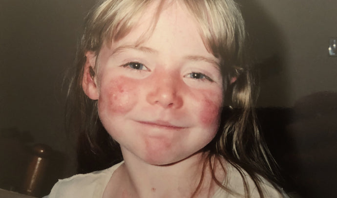 Epidermolysis bullosa