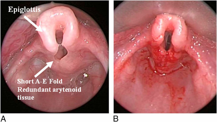 Epiglottitis