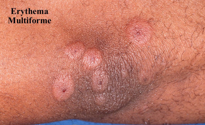 Erythema multiforme