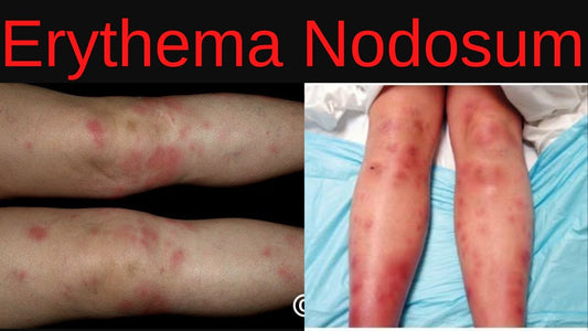 Erythema nodosum