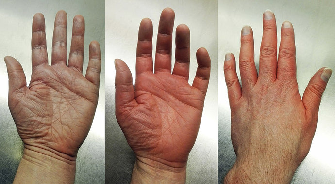 Erythromelalgia