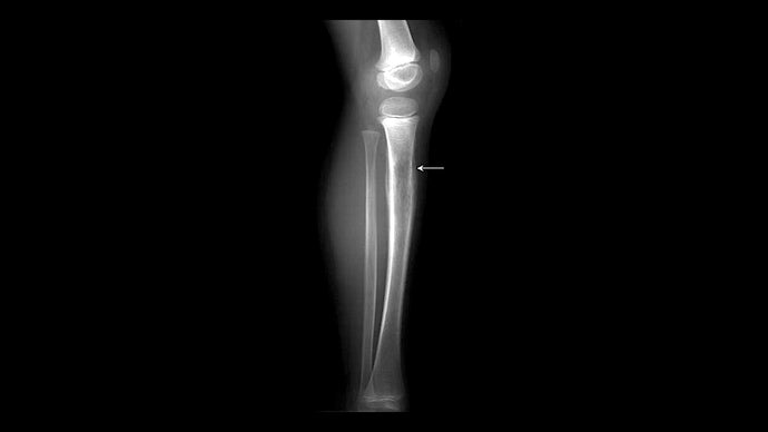 Ewing sarcoma