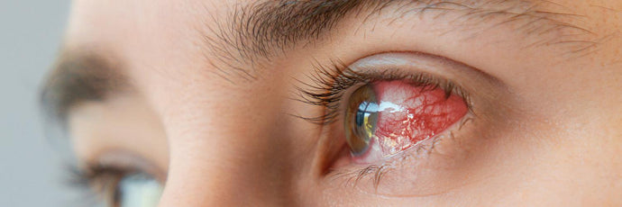 Eye infection (herpes)