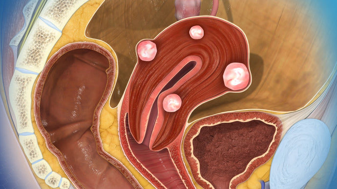 Fibroids