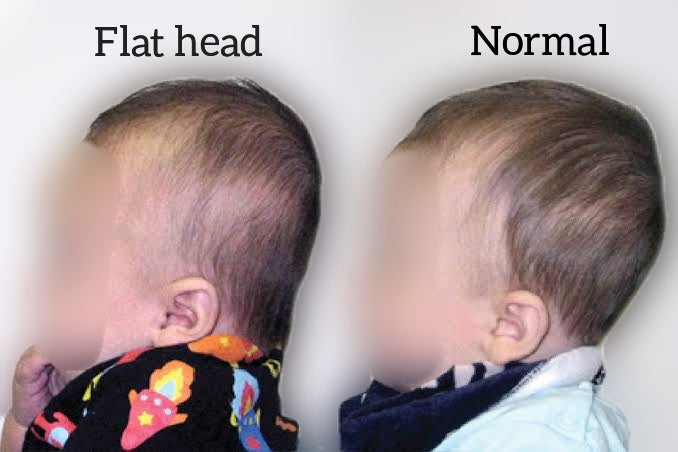 Flat head syndrome