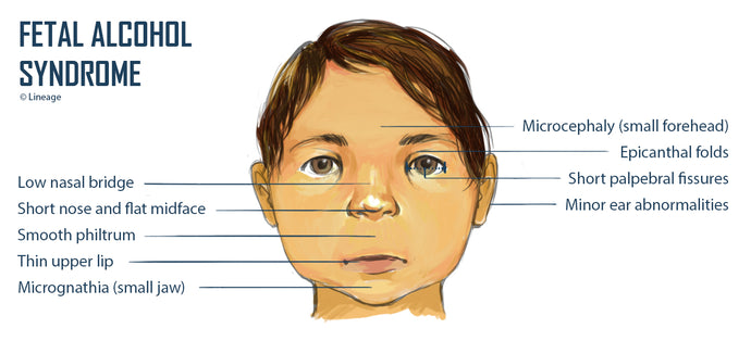 Foetal alcohol syndrome