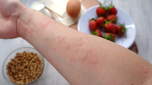 Food allergy