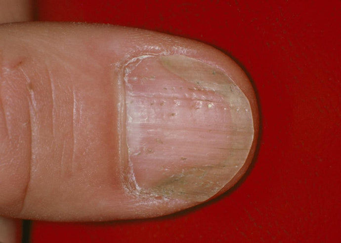 Fungal nail infection