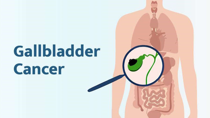 Gallbladder cancer