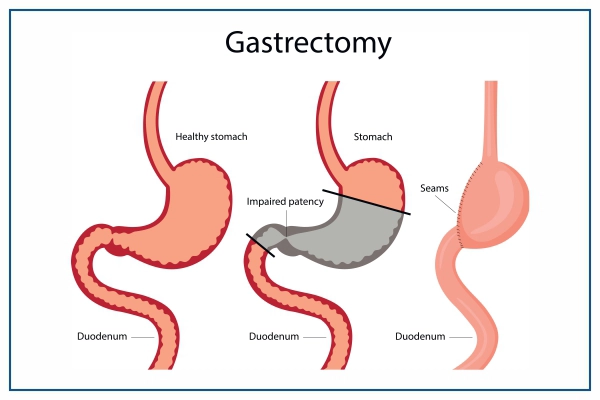 Gastrectomy