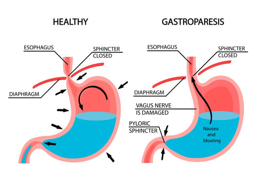 Gastroparesis