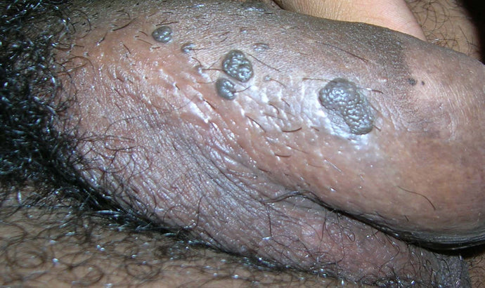 Genital warts