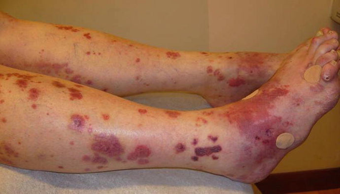 Granulomatosis with polyangiitis (Wegener's granulomatosis)