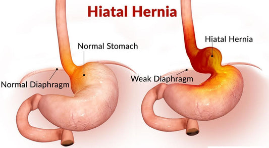 Hiatus hernia