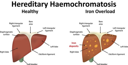 Haemochromatosis