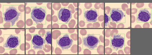 Hairy cell leukaemia