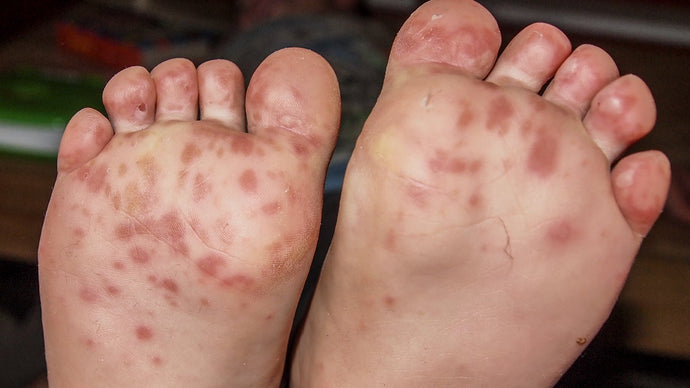 Hand, foot and mouth disease