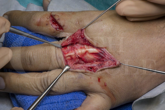 Hand tendon repair