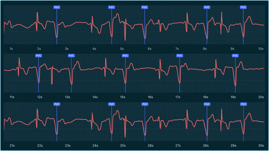 Heart rhythm problems