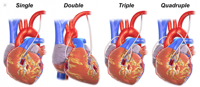 Heart bypass